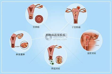 妇科病|妇科疾病（病症名称）